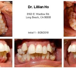 Orthodontics R Us - EDO Before