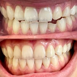 Valley Village Dentistry - 2 veneers - which ones are they? Most difficult thing in dentistry is to do single veneers, think we nailed it?