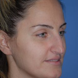 Associates in Plastic Surgery - Preop rhinoplasty