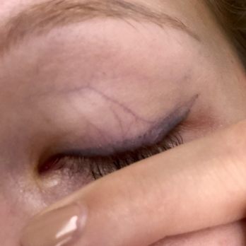 True Image - After over a year, liner still gray, faded, uneven, and misplaced - Permanent Makeup Near Me - New York, New York True Image - After over a year, liner still gray, faded, uneven, and misplaced - Permanent Makeup Near Me - New York, New York