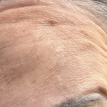 LaserAway - Tattoo Removal Near Me - San Diego, California