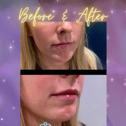 Beverley Kraszewski - IV Evolution - Natural lip filler before and after