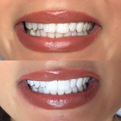 The Face Sytlist - Blanchiment dentaire/Teeth Whitening