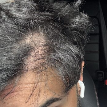 Care4Hair - Hair Loss Centers Near Me - Miami, Florida Care4Hair - Hair Loss Centers Near Me - Miami, Florida