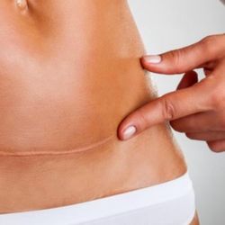 Florence Skin Care and Day Spa - Introducing the scar camouflaging permanent cosmetics here at BGMG cosmetics say good bye to those scars after cosmetic surgery