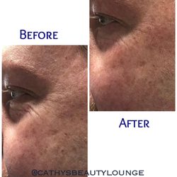 Cathy's Beauty Lounge - First session of Microchanneling. One down, 3 more to go!