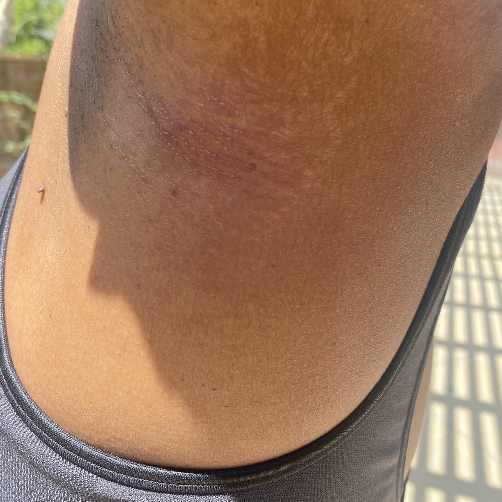 LaserAway - Left side back bra area burns - Medical Spas Near Me - Rancho Cucamonga, California LaserAway - Left side back bra area burns - Medical Spas Near Me - Rancho Cucamonga, California