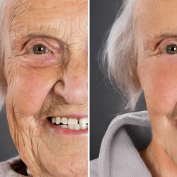 Skin and Beyond Wellness Center - Our oldest client is 94 year old! PDO Thread Lift, Filler, and a little of Botox. We are so glad to make a difference.