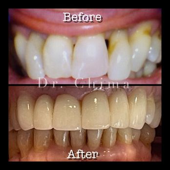 Bixby Hill Dental - Bixby Hill Dental does cosmetic, general, and emergency dentistry. Here, Dr. Chima did a combination of crowns, veneers, and root canals. - General Dentistry Near Me - Long Beach, California Bixby Hill Dental - Bixby Hill Dental does cosmetic, general, and emergency dentistry. Here, Dr. Chima did a combination of crowns, veneers, and root canals. - General Dentistry Near Me - Long Beach, California