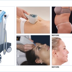 Renu Facial And Body Aesthetics - Exilis offers Body Shaping & Skin Tightening!