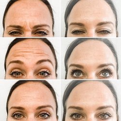 Before and After Botox with Alexis R.N