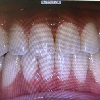 San Marcos Orthodontics - After braces - Orthodontists Near Me - San Marcos, California San Marcos Orthodontics - After braces - Orthodontists Near Me - San Marcos, California