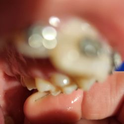 Gentle Dental Care - The wire in the back of his mouth