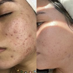 Skin Technology - Advance acne and discoloration treatment