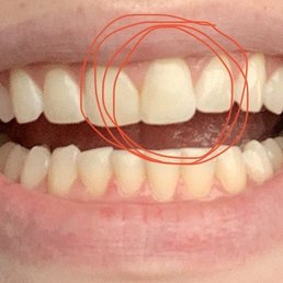 chipped front tooth repair chipped front tooth repair