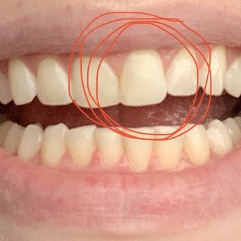 Lisa S Tilton, DDS - chipped front tooth repair - Cosmetic Dentists Near Me - Huntington Beach, California Lisa S Tilton, DDS - chipped front tooth repair - Cosmetic Dentists Near Me - Huntington Beach, California