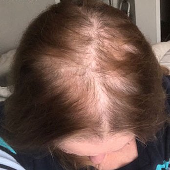 Celebration Salon Wigs and Extensions - This was my hair loss before coming to see Rhea - Hair Extensions Near Me - Alamo, California Celebration Salon Wigs and Extensions - This was my hair loss before coming to see Rhea - Hair Extensions Near Me - Alamo, California