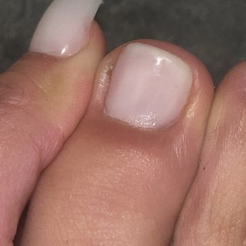Top A Nail - It got infected smh. - Nail Salons Near Me - New York, New York Top A Nail - It got infected smh. - Nail Salons Near Me - New York, New York