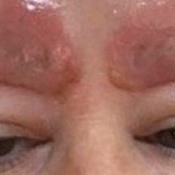 Brow Clinic Makeup SRQ - My eye brows after she scarred my brows. Took 2 months to finally go down. - Permanent Makeup Near Me - Sarasota, Florida