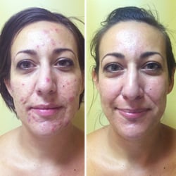 Brigitte Tolson Skincare & Esthetics - Before & After: Client with cystic acne and very dry skin after facials, recommended products, vitamins and herbs. Notice brighter eyes too.