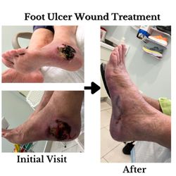 Suzuki Wound Care Clinic - Case study: 80yo diabetic infected foot wound. Healed with proper antibiotics and local wound care.