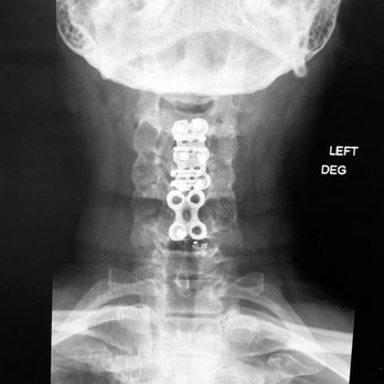 The Orthopaedic Institute - My hardware. Trust me I'd rather look like a "titanium woman" than have the pain I dealt with. I feel no pain! - Orthopedists Near Me - Gainesville, Florida