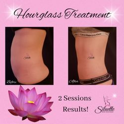 Siluette Body Sculpting