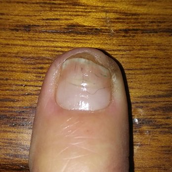 Kim's Pro Nails - Nail fungus from unclean tools after removal of acrylics - Nail Salons Near Me - Normal, Illinois