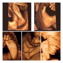 An Early Peek Ultrasound
