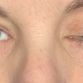 Schweiger Dermatology Group - This is day 10 after the injections. I can't open my eye. - Dermatologists Near Me - Smithtown, New York