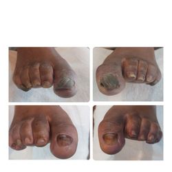 Heal ThyFeet Medical Pedicures - Before and after
Thick Discolored Toe nail