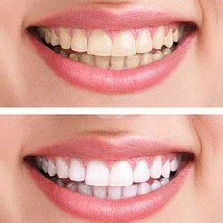 Affordable Dental Health Providers - Cosmetic Dentistry performed by ADHP. Look how white her teeth are afterwards!