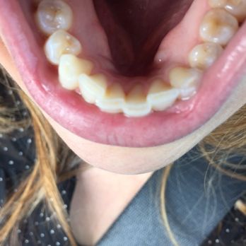 Dr. Abbo Advanced Dentistry - Here you can see that the bump from the previous picture is in this picture which was taken 7 months later. - Periodontists Near Me - North Miami Beach, Florida