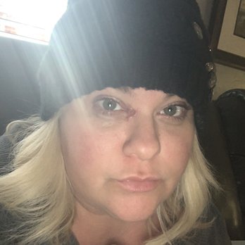 Steven Leibowitz, MD - Scabs have fallen off, and hike is closed. Still healing. - Ophthalmologists Near Me - Bakersfield, California Steven Leibowitz, MD - Scabs have fallen off, and hike is closed. Still healing. - Ophthalmologists Near Me - Bakersfield, California