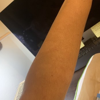 Seattle Sun Tan - After about a week - Tanning Near Me - Redmond, Washington