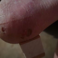 New York Nails - Damage due to rough treatment. Hard to see, but look at right side above bandage.