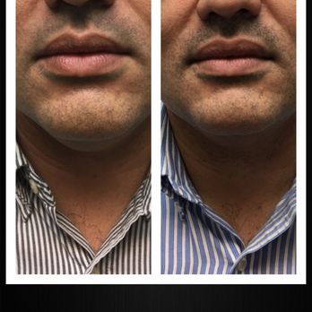 Allure Laser Studio - Trusculpt3d on the neck amazing results - Medical Spas Near Me - Houston, Texas Allure Laser Studio - Trusculpt3d on the neck amazing results - Medical Spas Near Me - Houston, Texas