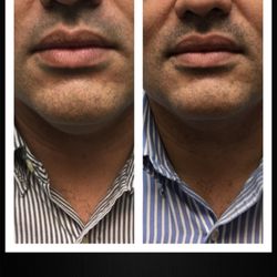 Allure Laser Studio - Trusculpt3d on the neck amazing results