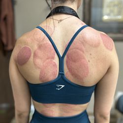 Beyond The Surface Massage Therapy - Cupping releases painful trigger points, improves blood and lymph circulation, relieves pain, promotes mobility and range of motion.
