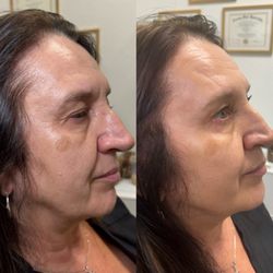 HD Beauty - Cheek and jawline augmentation with Radiesse