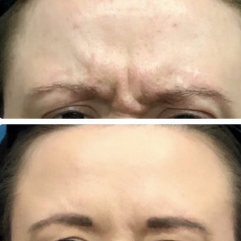 Luxe Beauty Now - Botox before And after - Medical Spas Near Me - Bedford, Texas