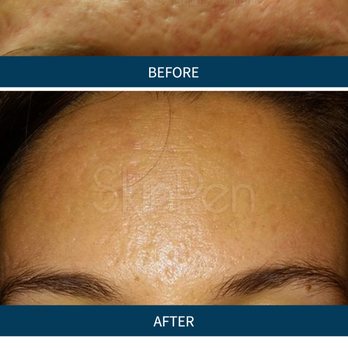 Plastic Surgery Associates - MicroNeedling - Medical Spas Near Me - Greenville, South Carolina Plastic Surgery Associates - MicroNeedling - Medical Spas Near Me - Greenville, South Carolina