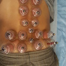 Atlantic Center for Acupuncture - Cupping for muscle soreness and pain