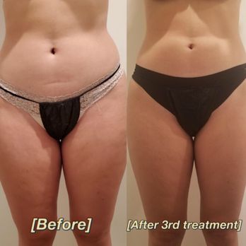 Wholistic Space - Start today! Call for a free consultation appointment!!! - Body Contouring Near Me - Torrance, California Wholistic Space - Start today! Call for a free consultation appointment!!! - Body Contouring Near Me - Torrance, California