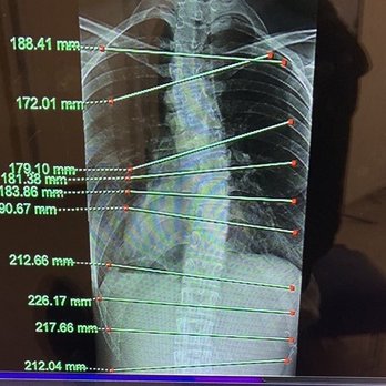 The Disc Chiropractic - you'll get full body X-rays so he can see exactly what he's doing. here's my squiggly spine (: - Chiropractors Near Me - Wheat Ridge, Colorado