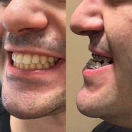 Before and after braces + surgery. Before and after braces + surgery.