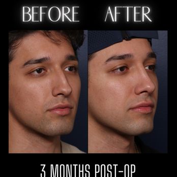 Inland Cosmetic Surgery - RHINOPLASTY - Cosmetic Surgeons Near Me - Rancho Cucamonga, California Inland Cosmetic Surgery - RHINOPLASTY - Cosmetic Surgeons Near Me - Rancho Cucamonga, California