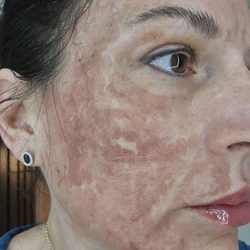 Body Beautiful Laser Medi-Spa - 48 hrs after pearl laser