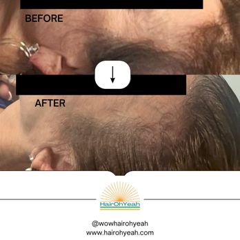 Hair Oh Yeah - Hair Loss Centers Near Me - Bellevue, Washington Hair Oh Yeah - Hair Loss Centers Near Me - Bellevue, Washington