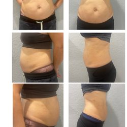 Lotus Massage and Rehabilitation - Advanced Body Sculpting Treatments Available. Lose up to 10" of body fat.